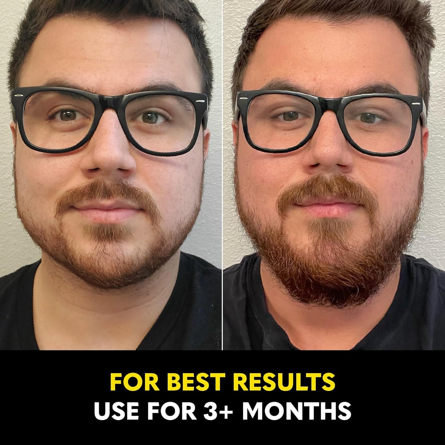 Beard Club - Beard Growth Serum with Natural Castor, Coconut and Avocado to Grow a Thicker, Fuller Beard, Fill in Patches and Stimulate Healthier Facial Hair Growth