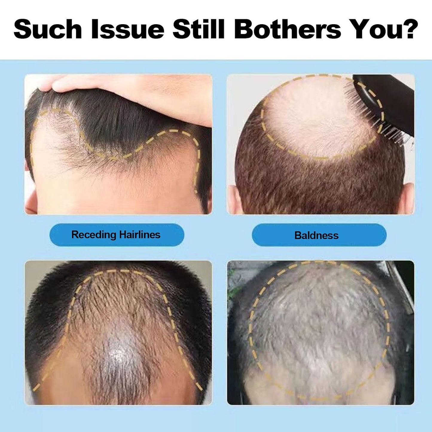 5% Minoxidil for Men Hair, Minoxidil Hair Growth Serum for Women Hair Growth, Men Beard Growth, Hair Loss Treatment with Dropper Applicator & Massage Tool