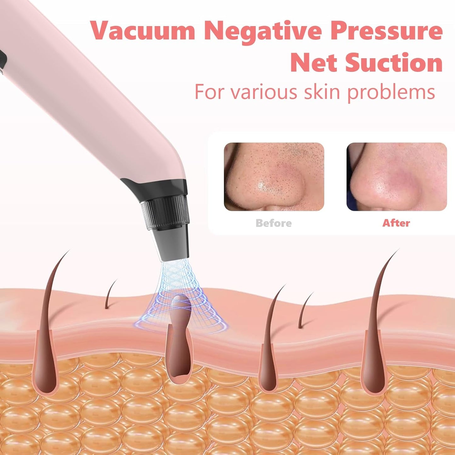 Blackhead Remover Vacuum - Black Head Remover for Face,Blackhead Extractor Tool with 3 Adjustable Suction Levels,4 Probes,USB Interface Type Pore Vacuum,Suitable for Women and Men (Pink)