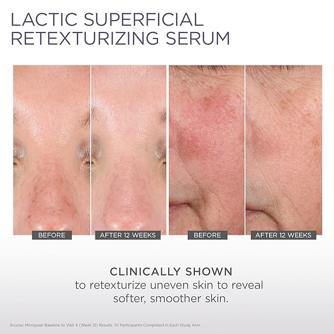 Glytone Micro-Peel Lactic Superficial Retexturizing Serum | Anti-Aging AHA Exfoliating Serum for Face with 10% Lactic Acid | Hydrates, Brightens & Reduces Wrinkles | Paraben-Free - 1 Fl oz