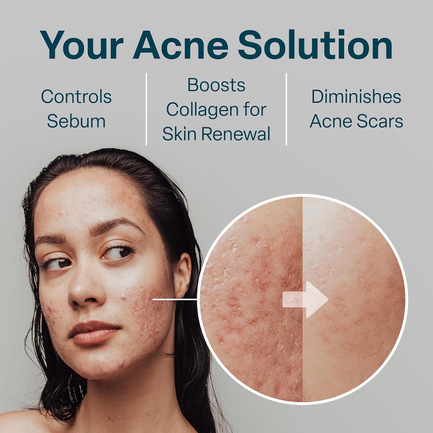 QRxLabs Salicylic & Glycolic Acid Pads (2% Salicylic & 10% Glycolic) - 50 Count Jar - Exfoliating Pads for Acne & Bacne Treatment with Vitamins B5, C & E & Calendula & Green Tea